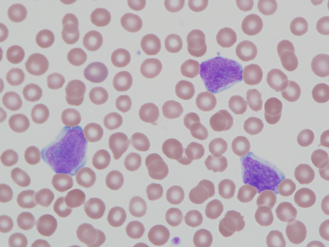 Figure 1d: Peripheral blood smear highlighting blast morphology (1000x magnification).